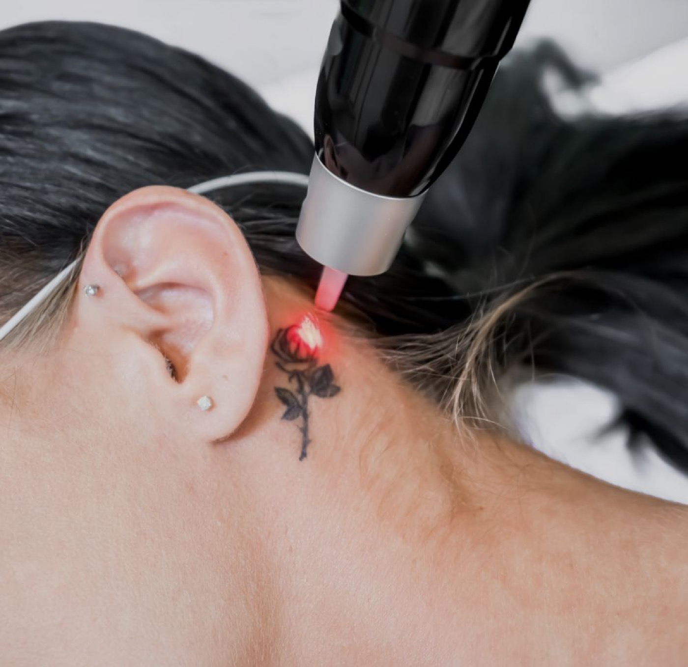 Laser-Tattooentfernung
